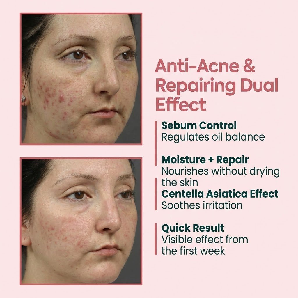 Acne & Pimple Cream with Zinc PCA, Centella, Niacinamide - 40ml - TryAladdin