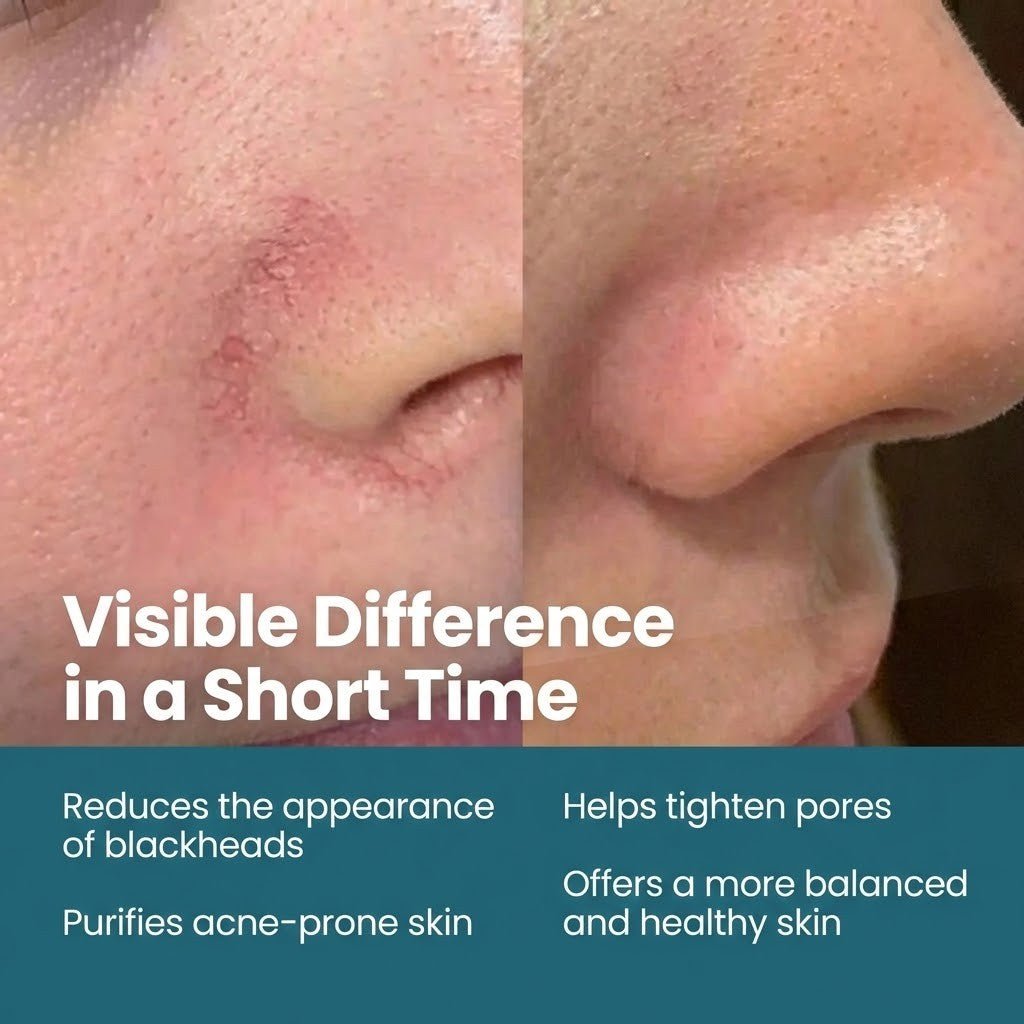Anti - Blackhead & Acne Serum with Niacinamide & Zinc PCA - 50ml - TryAladdin