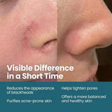 Anti - Blackhead & Acne Serum with Niacinamide & Zinc PCA - 50ml - TryAladdin